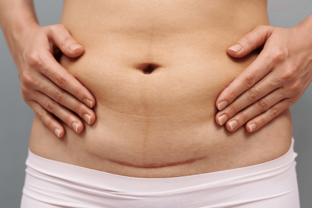 Understanding caesarean section delivery