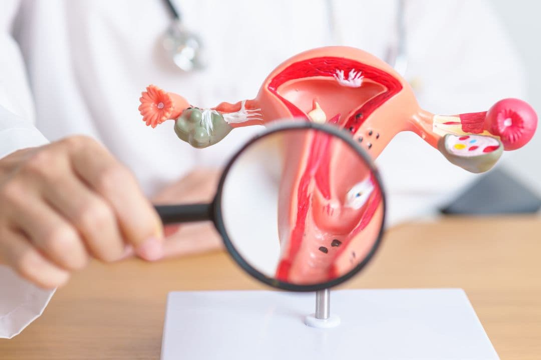 Endometriosis