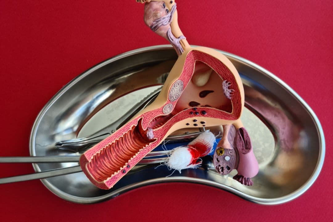 Understanding hysterectomy
