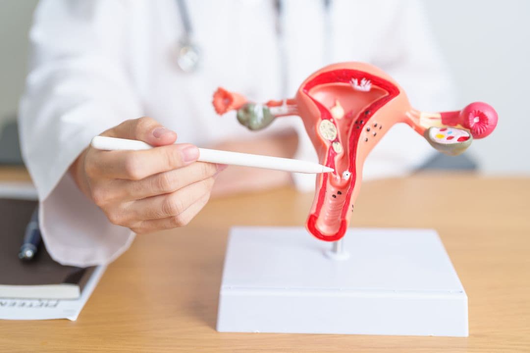 Ovarian Cysts